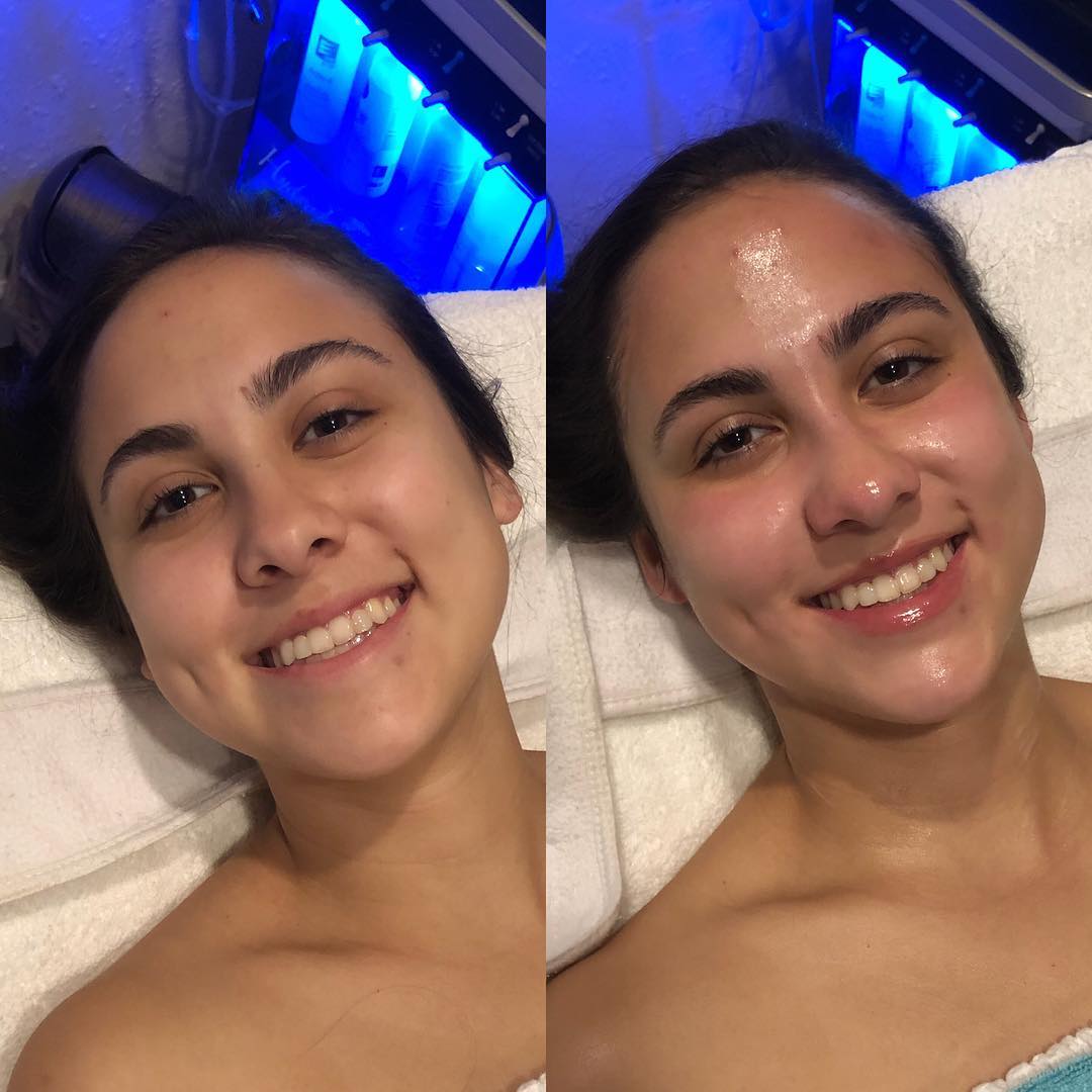 Resultado de antes y después en Hidratación