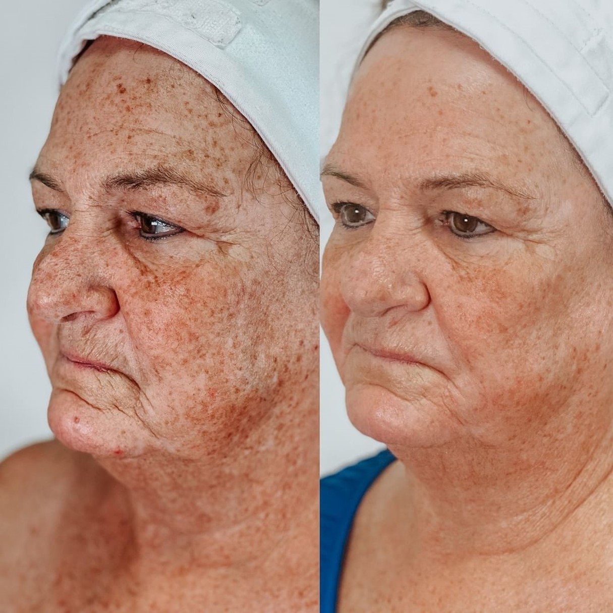 Resultado de antes y después en Hiperpigmentación