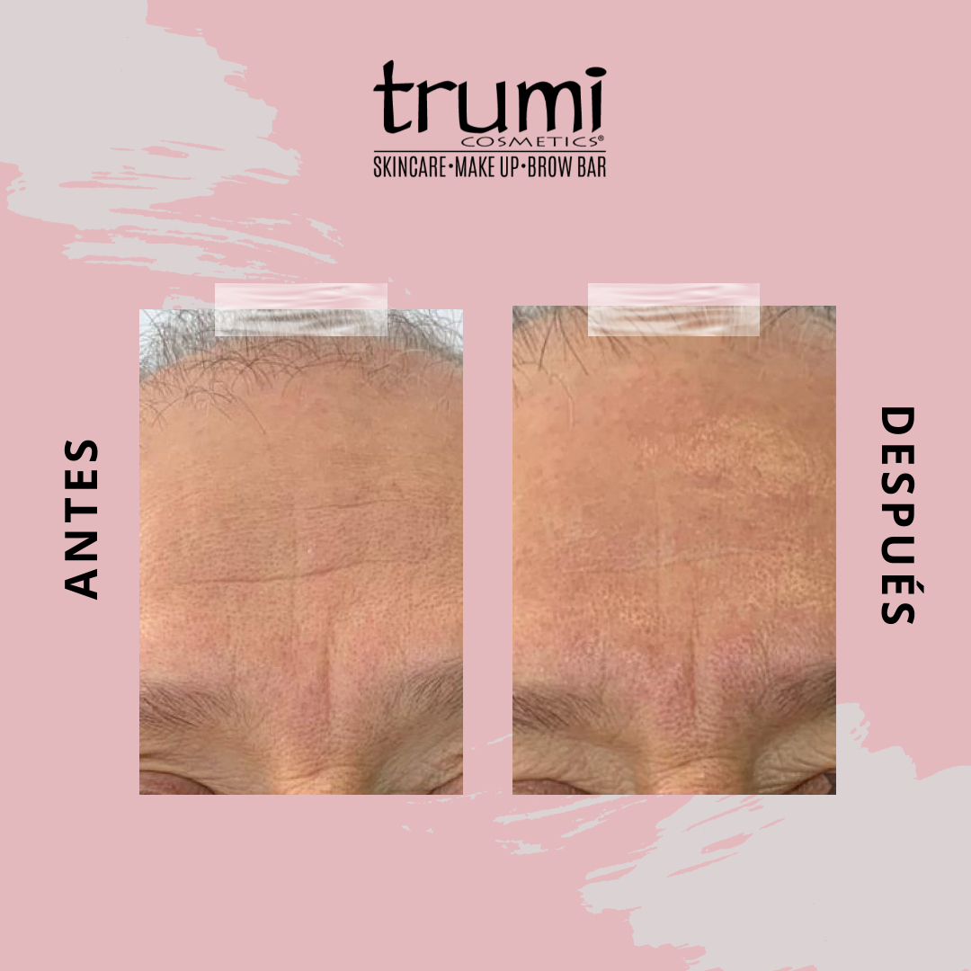 Antes y Despues Hydrafacial con Trumi Cosmetics