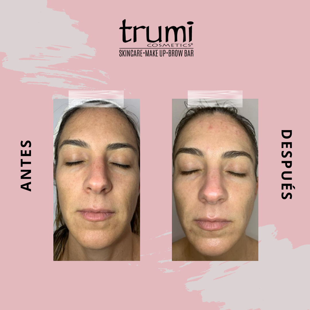 Antes y Despues Vitamina C con Trumi Cosmetics