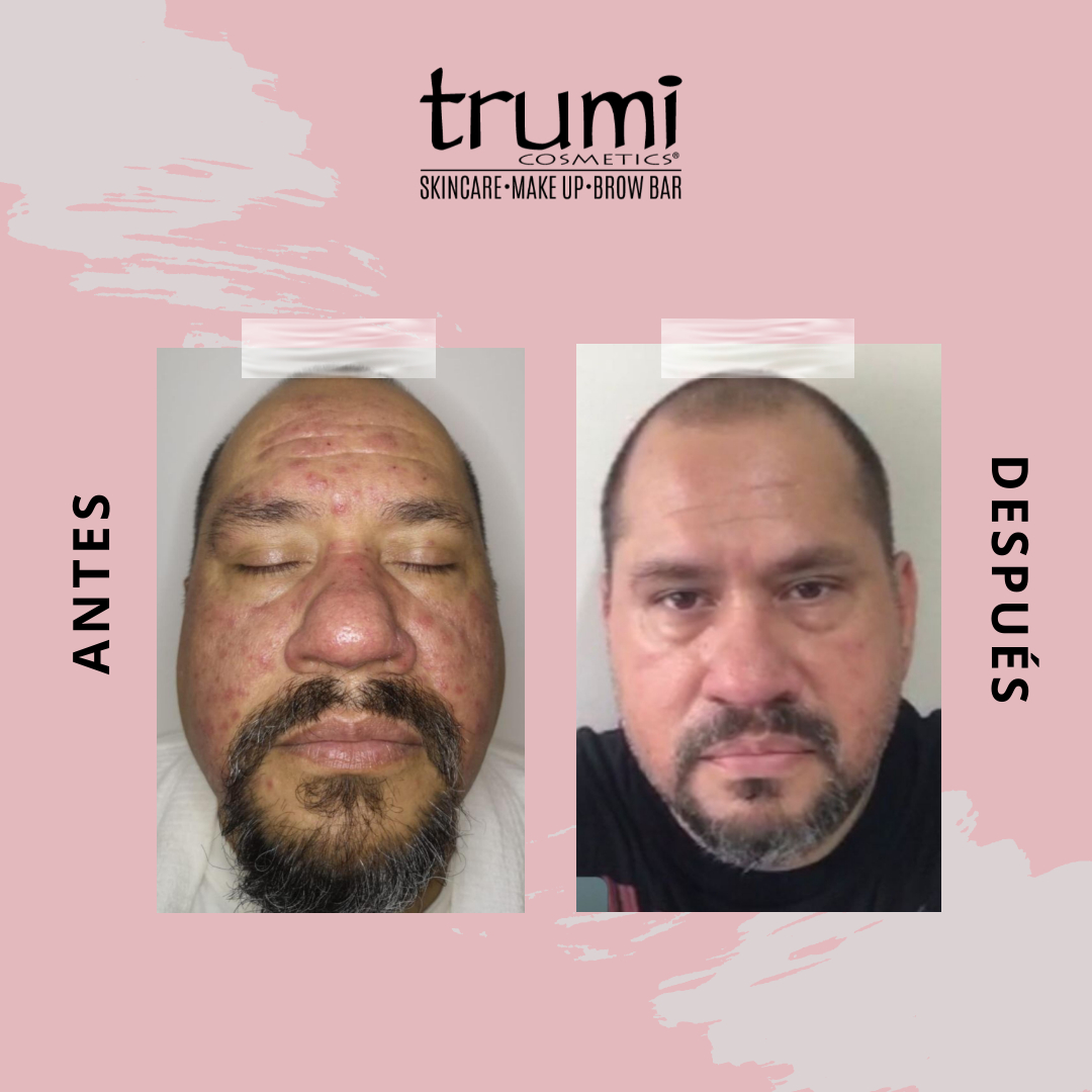 Antes y despues Oxyderme Facial THBO con Trumi Cosmetics