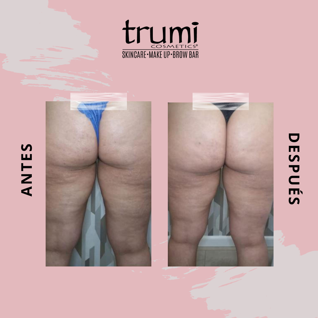 Antes y despues Radio Frecuencia con Trumi Cosmetics