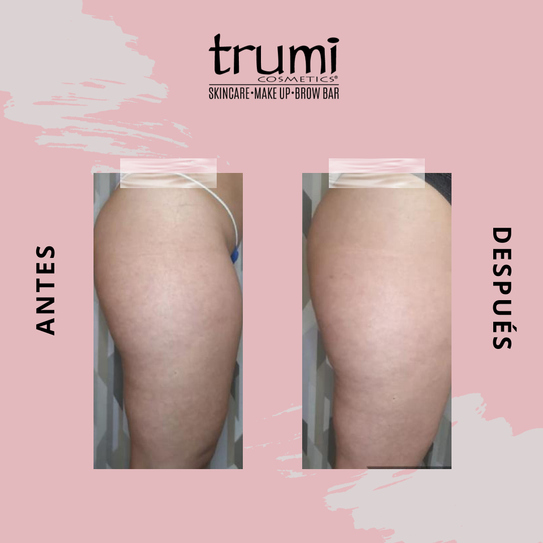 Antes y despues Radio Frecuencia con Trumi Cosmetics