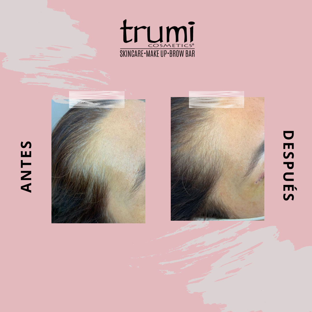 Antes y Despues Keravive con Trumi Cosmetics