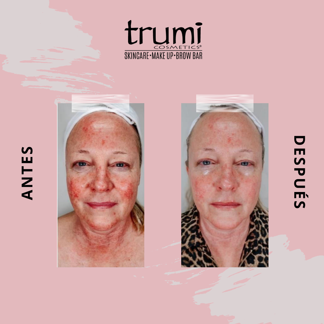 Antes y Despues Your Time con Trumi Cosmetics